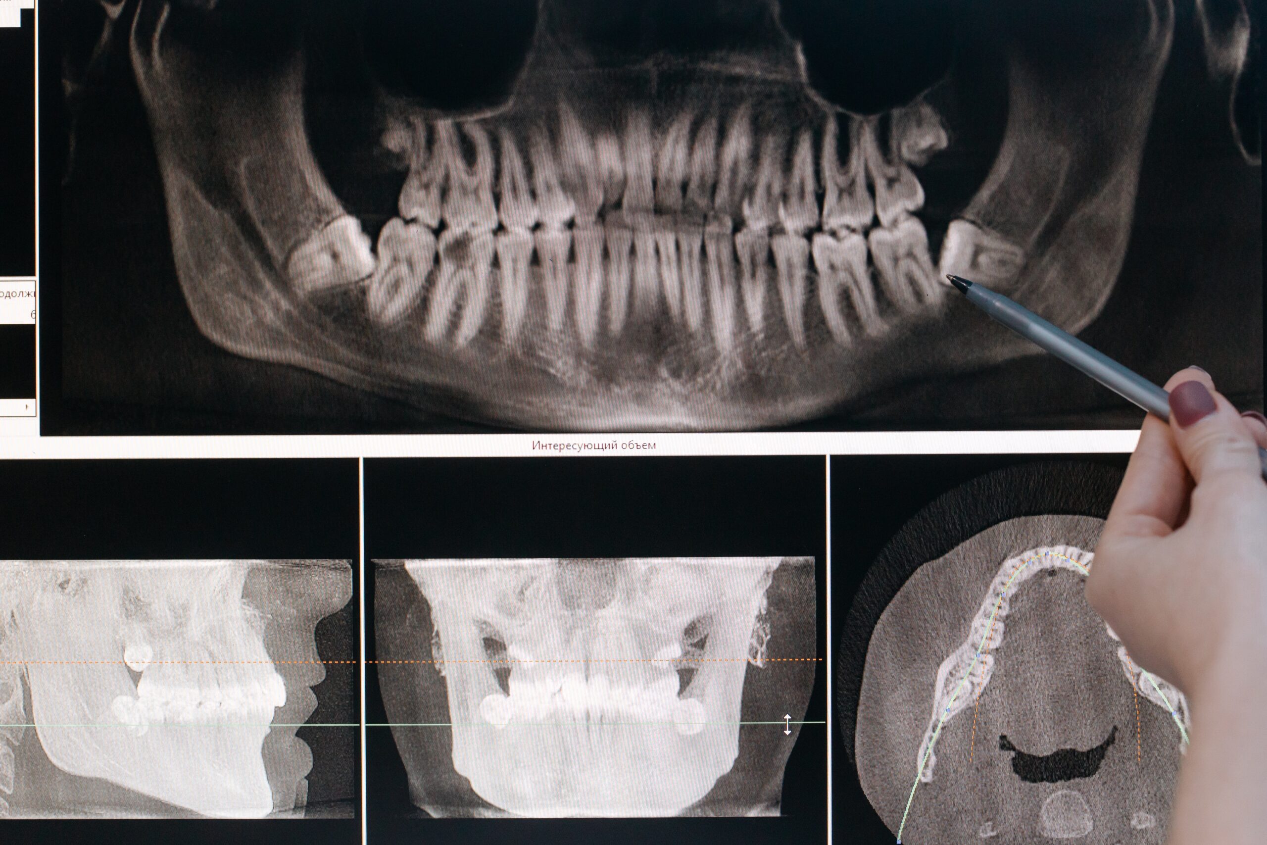 xray images of the mouth and teeth